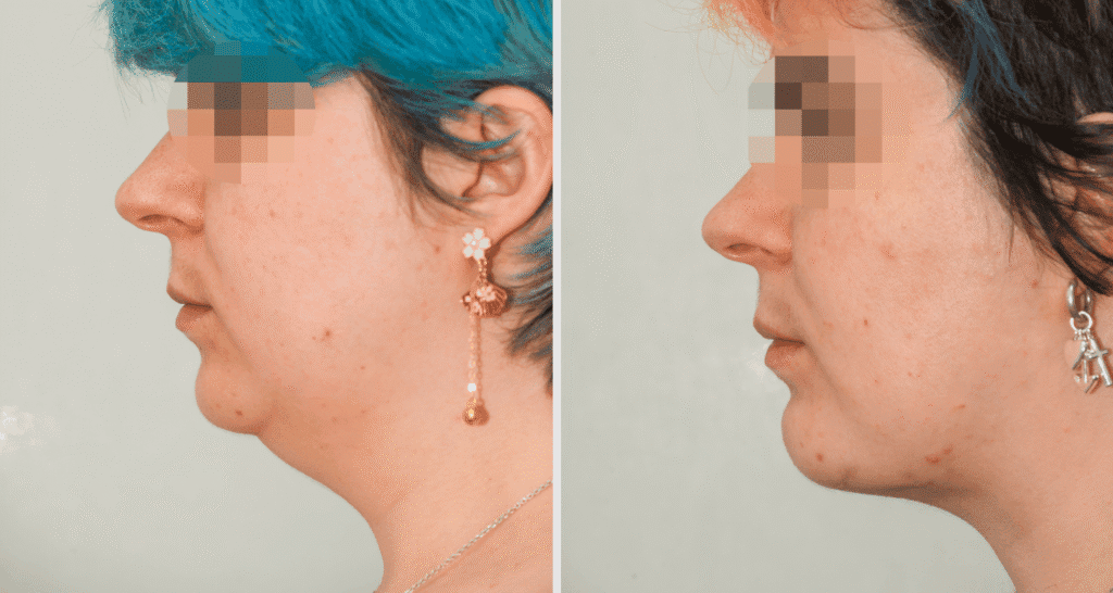 Vorher/Nachher Ergebnis: Kinnkorrektur Vergroesserung