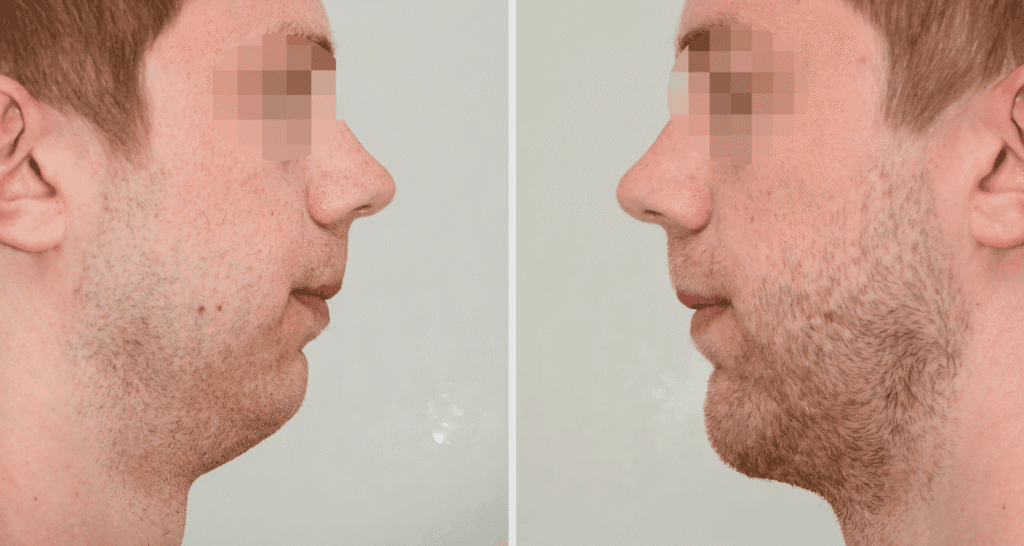 Vorher/Nachher Ergebnis: Kinnkorrektur Vergroesserung