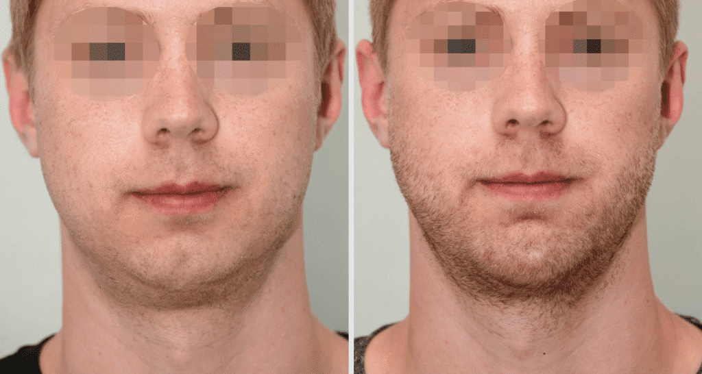 Vorher/Nachher Ergebnis: Kinnkorrektur Vergroesserung