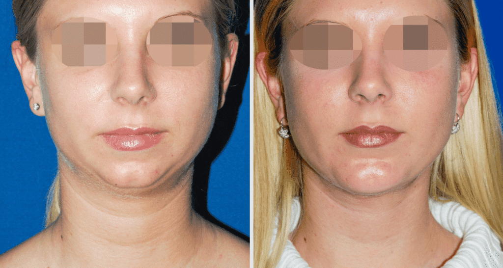 Vorher/Nachher Ergebnis: Kinnkorrektur Vergroesserung