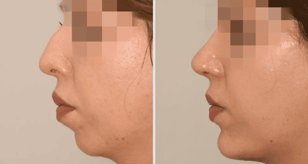 Vorher/Nachher Ergebnis: Kinnkorrektur Vergroesserung