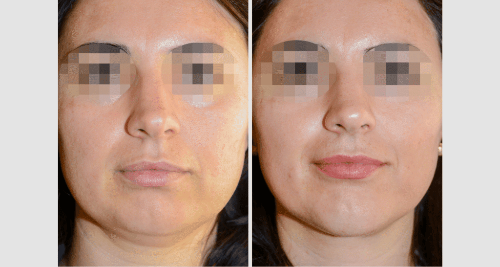 Vorher/Nachher Ergebnis: Kinnkorrektur Vergroesserung