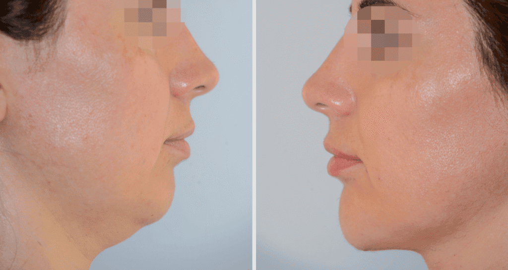 Vorher/Nachher Ergebnis: Kinnkorrektur Vergroesserung