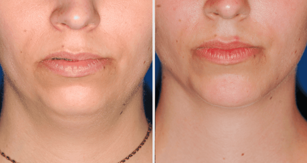 Vorher/Nachher Ergebnis: Kinnkorrektur Vergroesserung