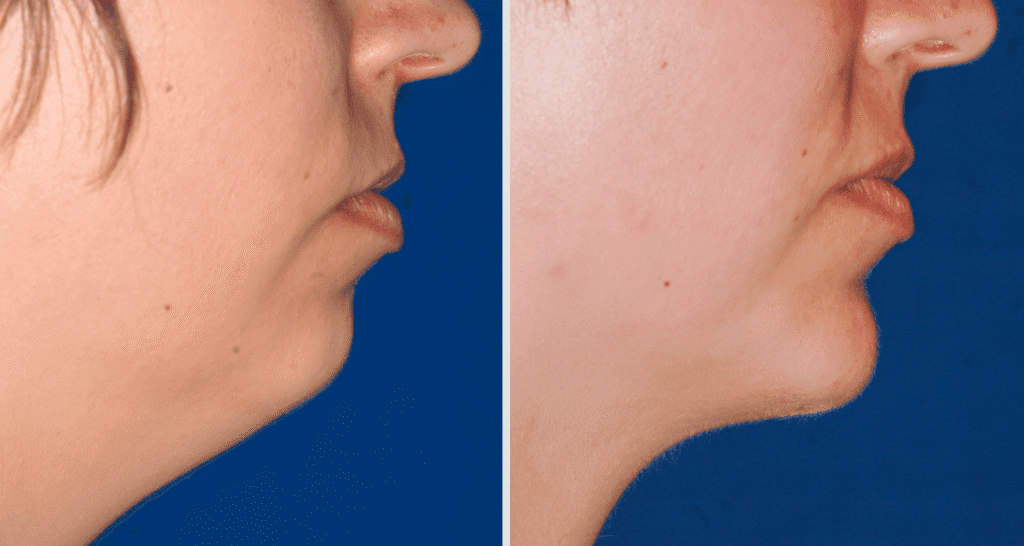 Vorher/Nachher Ergebnis: Kinnkorrektur Vergroesserung