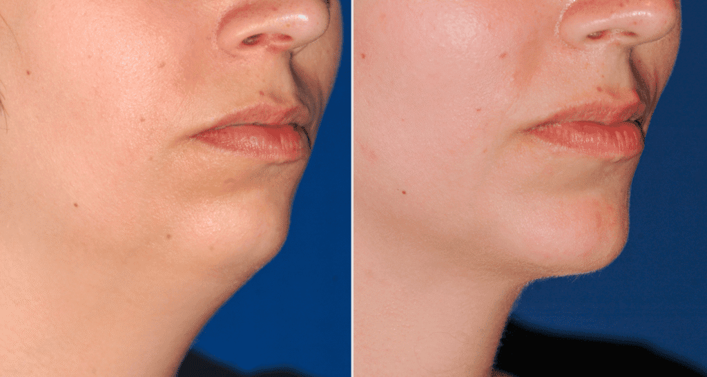 Vorher/Nachher Ergebnis: Kinnkorrektur Vergroesserung