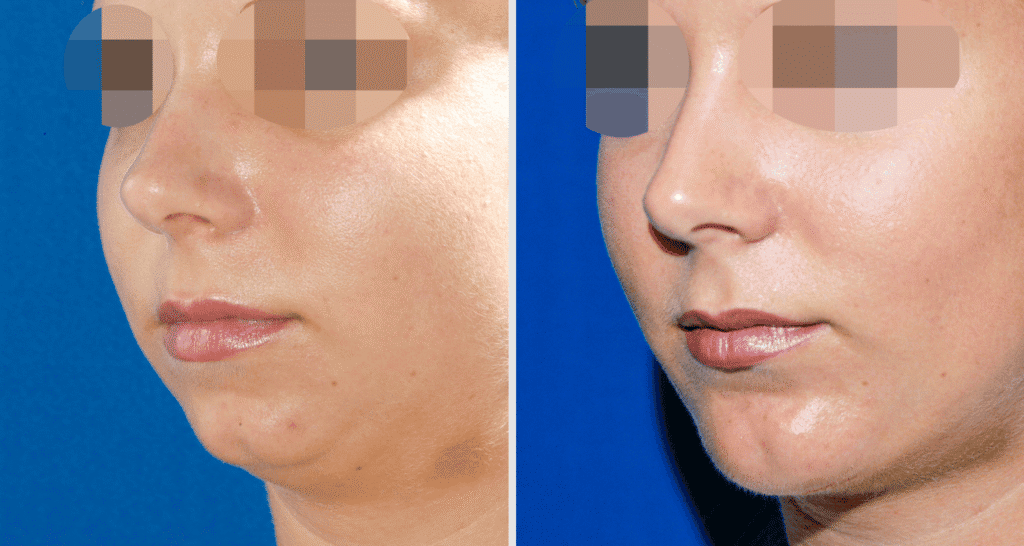 Vorher/Nachher Ergebnis: Kinnkorrektur Vergroesserung