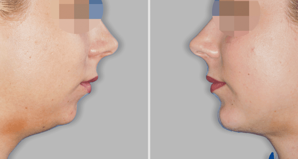 Vorher/Nachher Ergebnis: Kinnkorrektur Vergroesserung