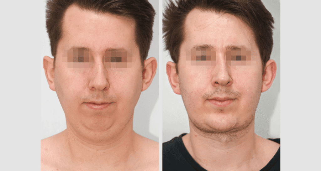 Vorher/Nachher Ergebnis: Kinnkorrektur Vergroesserung