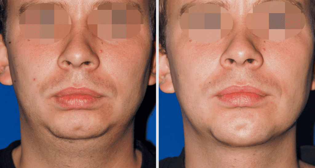 Vorher/Nachher Ergebnis: Kinnkorrektur Vergroesserung