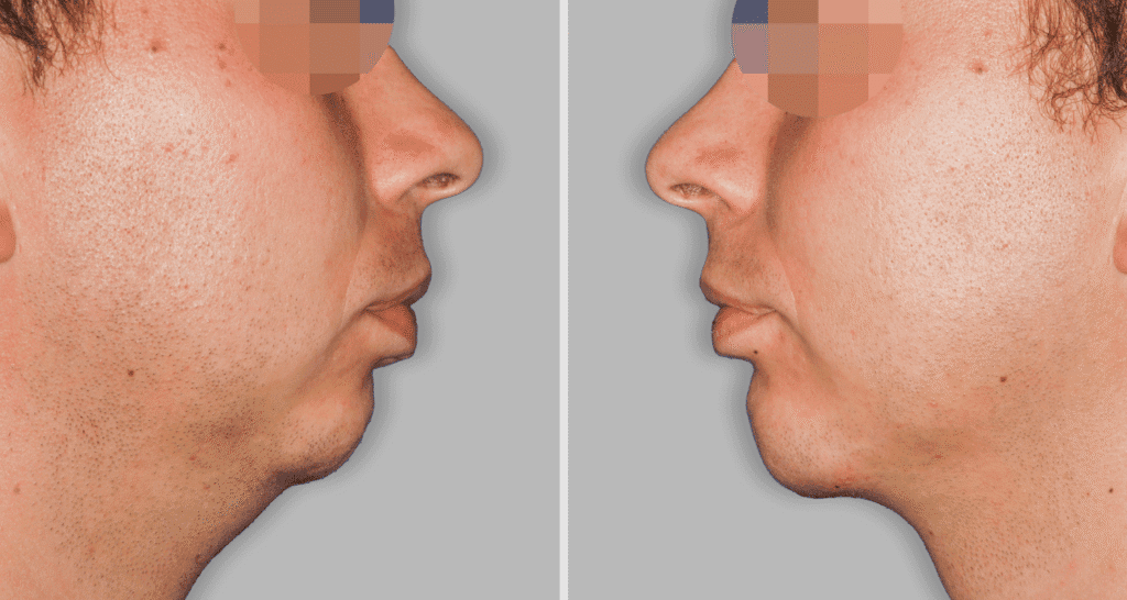 Vorher/Nachher Ergebnis: Kinnkorrektur Vergroesserung