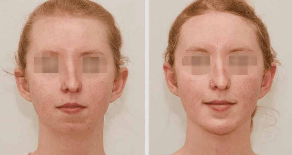 Vorher/Nachher Ergebnis: Kinnkorrektur Vergroesserung