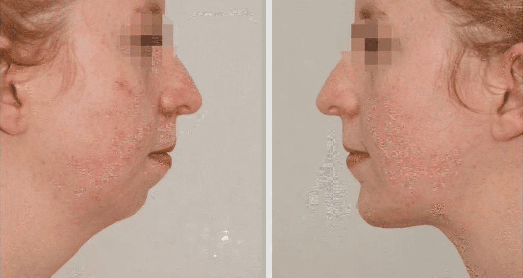 Vorher/Nachher Ergebnis: Kinnkorrektur Vergroesserung