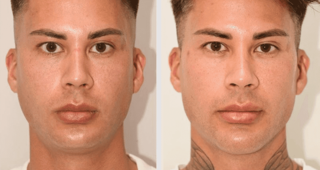 Vorher/Nachher Ergebnis: Kinnkorrektur Vergroesserung