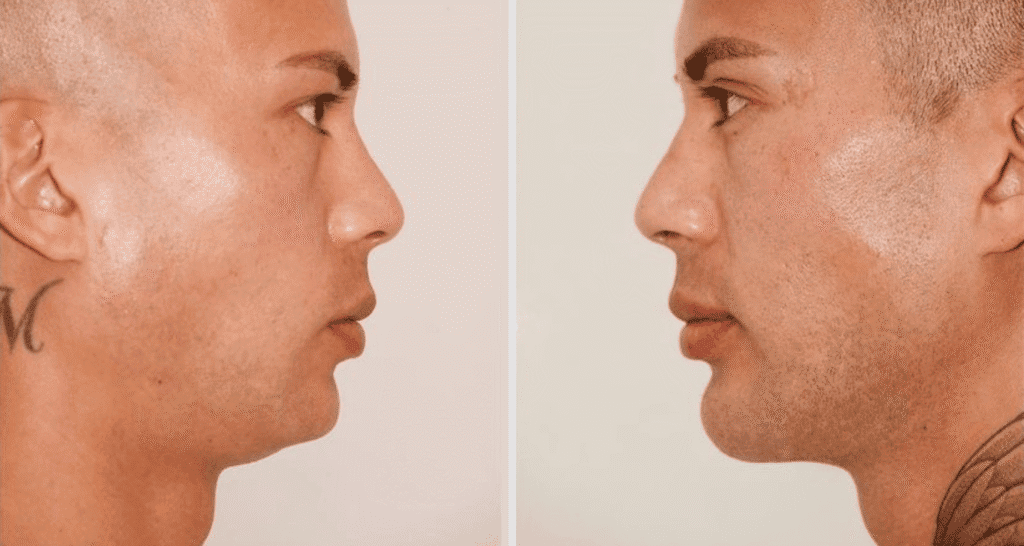 Vorher/Nachher Ergebnis: Kinnkorrektur Vergroesserung