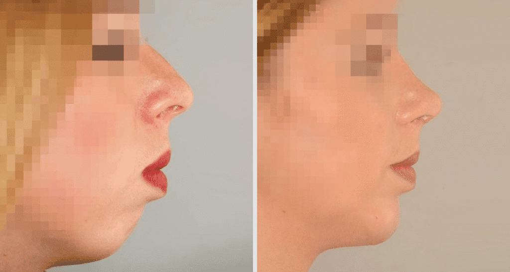 Vorher/Nachher Ergebnis: Kinnkorrektur Vergroesserung