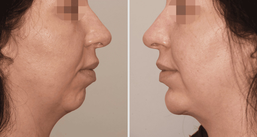 Vorher/Nachher Ergebnis: Kinnkorrektur Vergroesserung