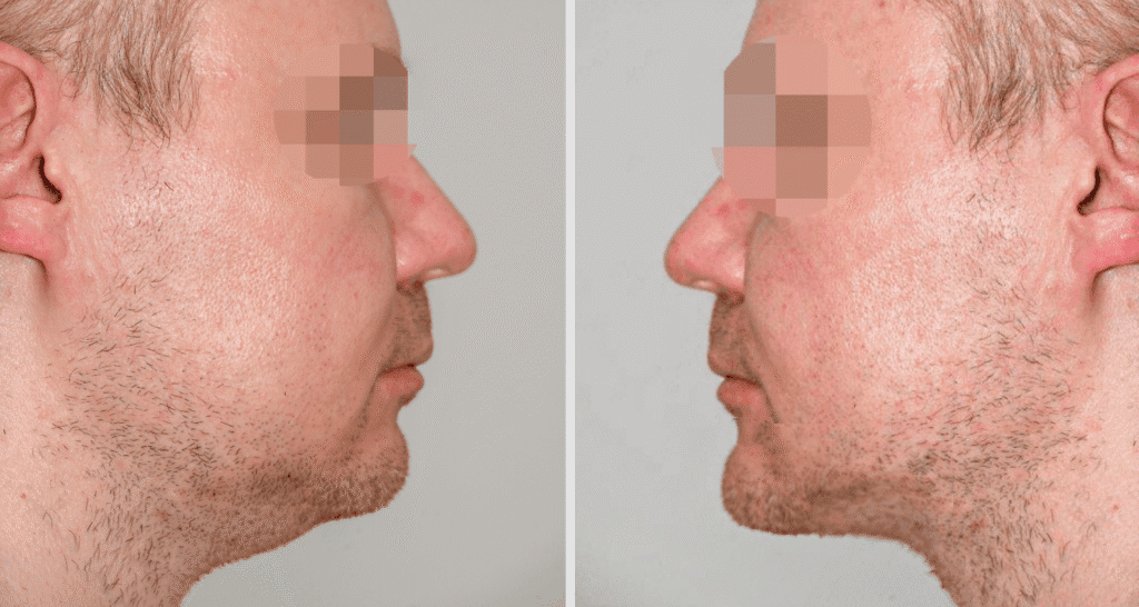 Vorher/Nachher Ergebnis: Kinnkorrektur Vergroesserung