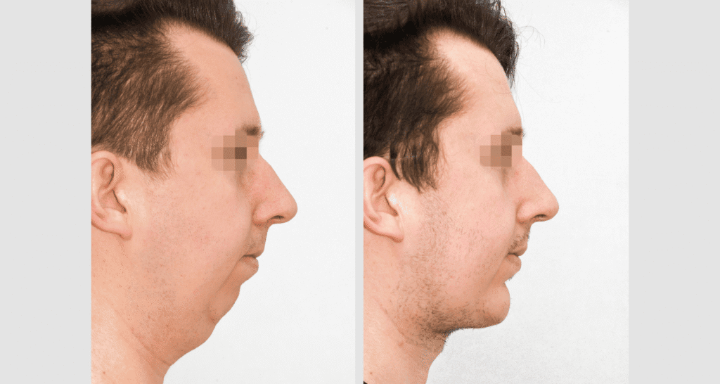 Vorher/Nachher Ergebnis: Kinnkorrektur Vergroesserung