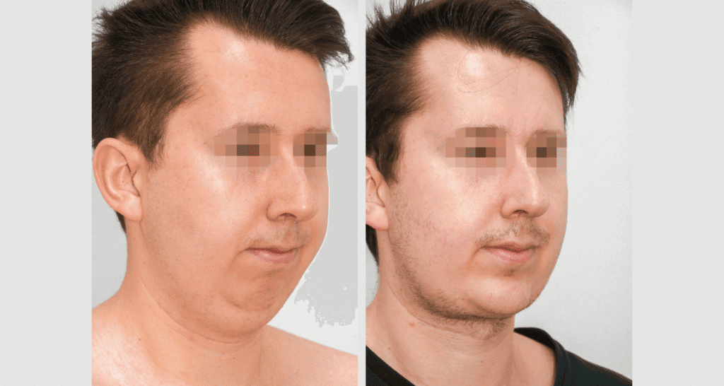 Vorher/Nachher Ergebnis: Kinnkorrektur Vergroesserung