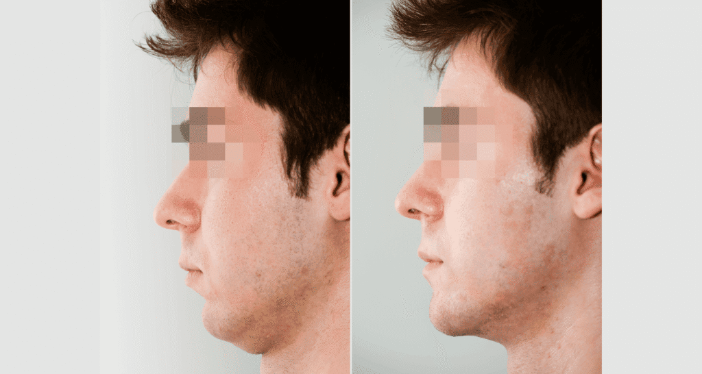 Vorher/Nachher Ergebnis: Kinnkorrektur Vergroesserung