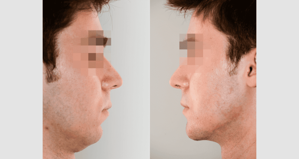 Vorher/Nachher Ergebnis: Kinnkorrektur Vergroesserung