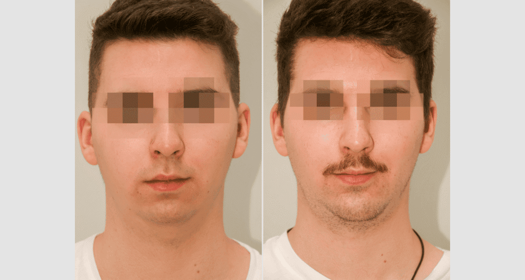 Vorher/Nachher Ergebnis: Kinnkorrektur Vergroesserung