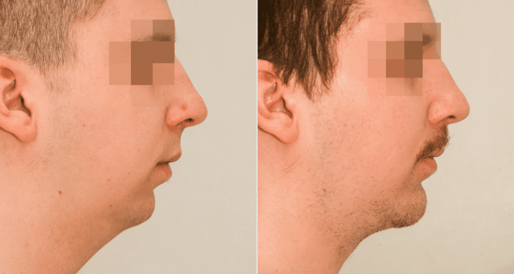 Vorher/Nachher Ergebnis: Kinnkorrektur Vergroesserung