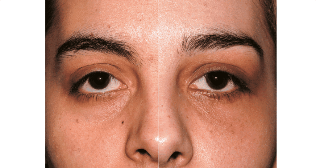 Vorher/Nachher Ergebnis: Korrektur Dackelaugen Canthoplastik