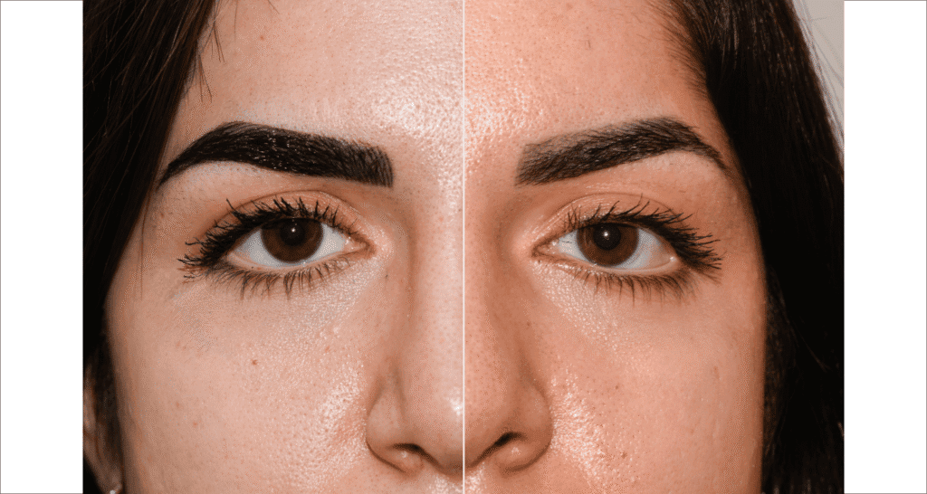 Vorher/Nachher Ergebnis: Korrektur Dackelaugen Canthoplastik