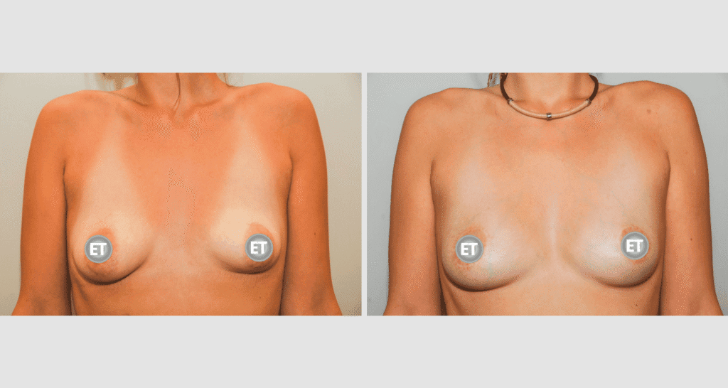 Vorher/Nachher Ergebnis: Mammatubulaere Deformitaet