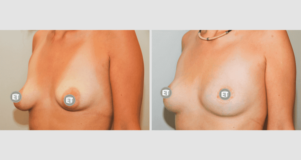 Vorher/Nachher Ergebnis: Mammatubulaere Deformitaet