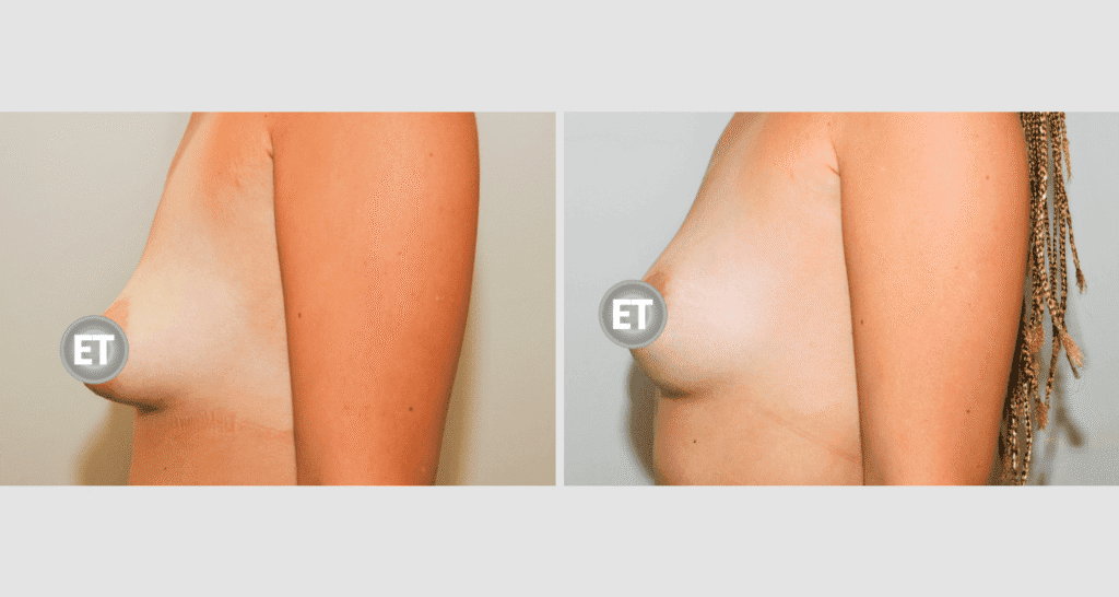 Vorher/Nachher Ergebnis: Mammatubulaere Deformitaet