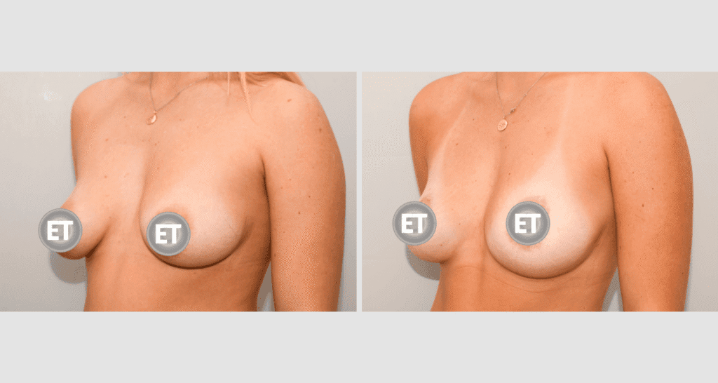 Vorher/Nachher Ergebnis: Mammatubulaere Deformitaet