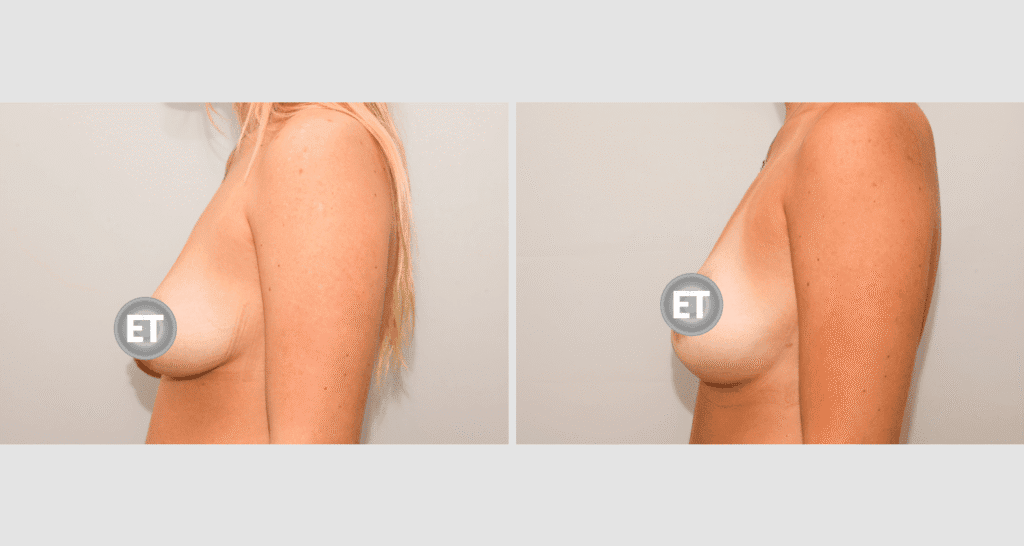 Vorher/Nachher Ergebnis: Mammatubulaere Deformitaet