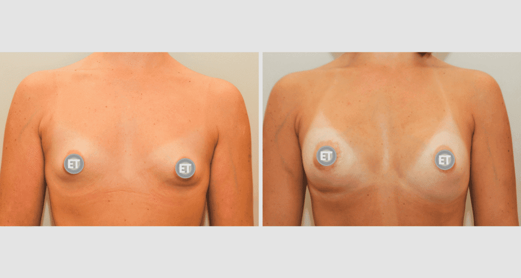 Vorher/Nachher Ergebnis: Mammatubulaere Deformitaet