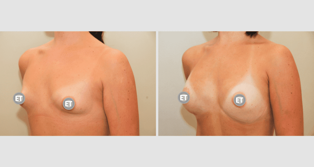 Vorher/Nachher Ergebnis: Mammatubulaere Deformitaet