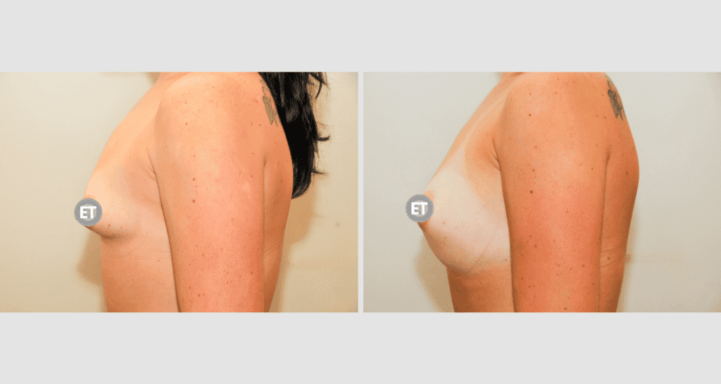 Vorher/Nachher Ergebnis: Mammatubulaere Deformitaet