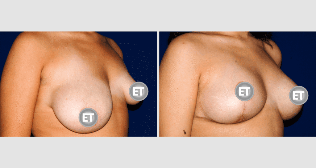 Vorher/Nachher Ergebnis: Mammatubulaere Deformitaet