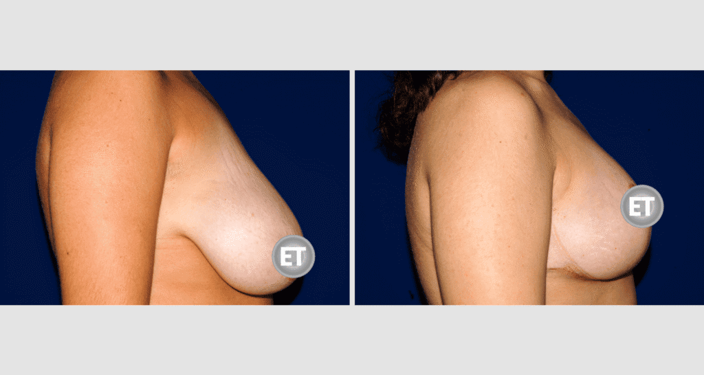 Vorher/Nachher Ergebnis: Mammatubulaere Deformitaet 13b