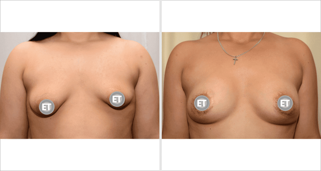 Vorher/Nachher Ergebnis: Mammatubulaere Deformitaet