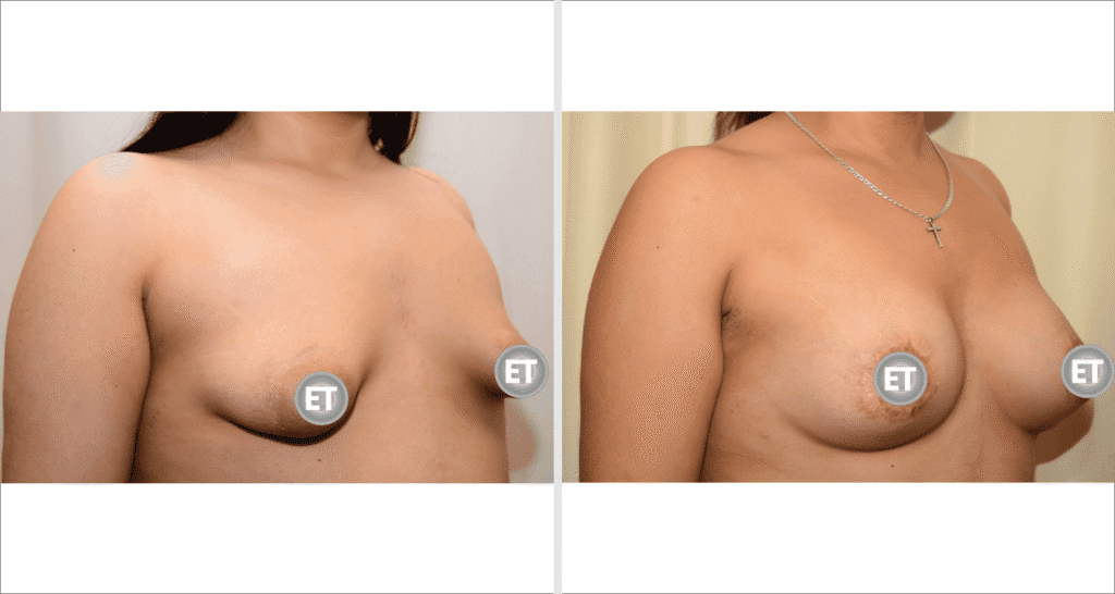 Vorher/Nachher Ergebnis: Mammatubulaere Deformitaet