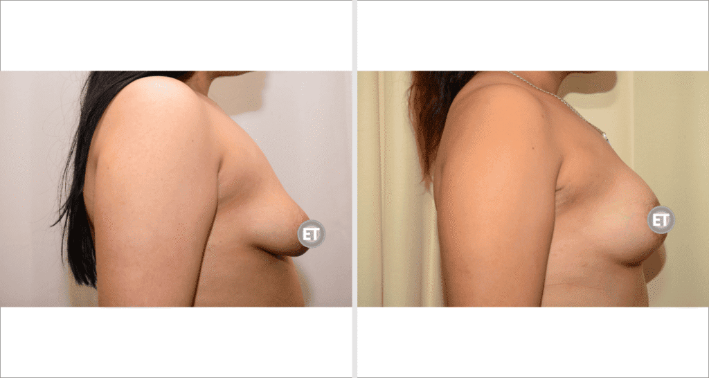 Vorher/Nachher Ergebnis: Mammatubulaere Deformitaet