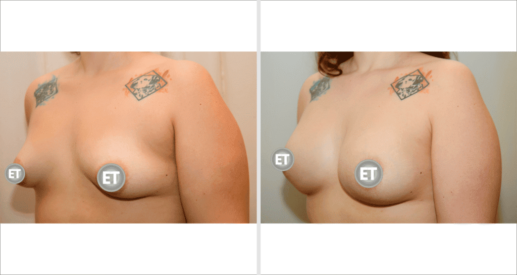 Vorher/Nachher Ergebnis: Mammatubulaere Deformitaet