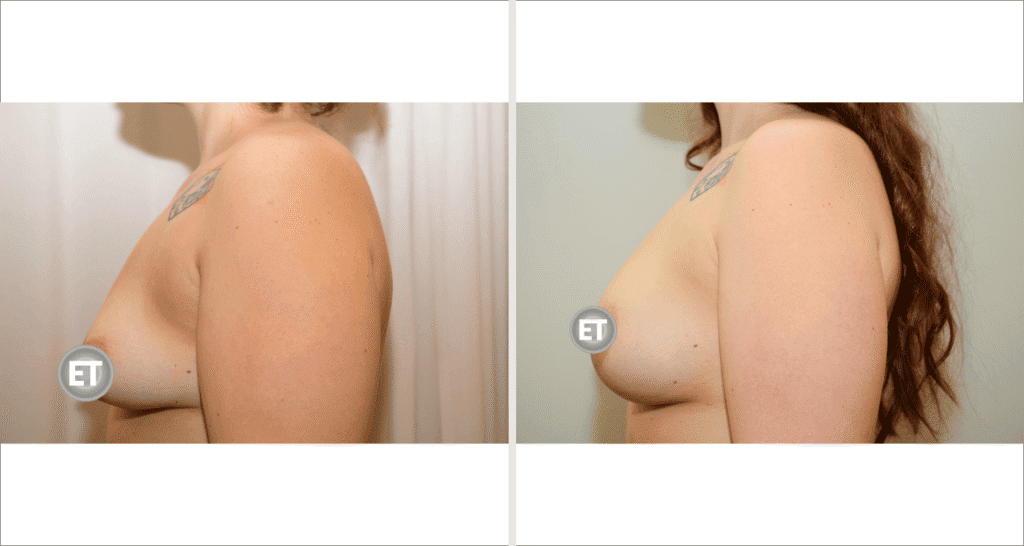 Vorher/Nachher Ergebnis: Mammatubulaere Deformitaet