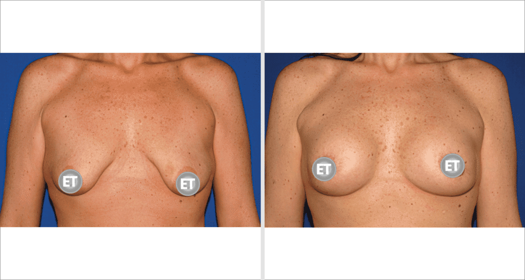 Vorher/Nachher Ergebnis: Mammatubulaere Deformitaet