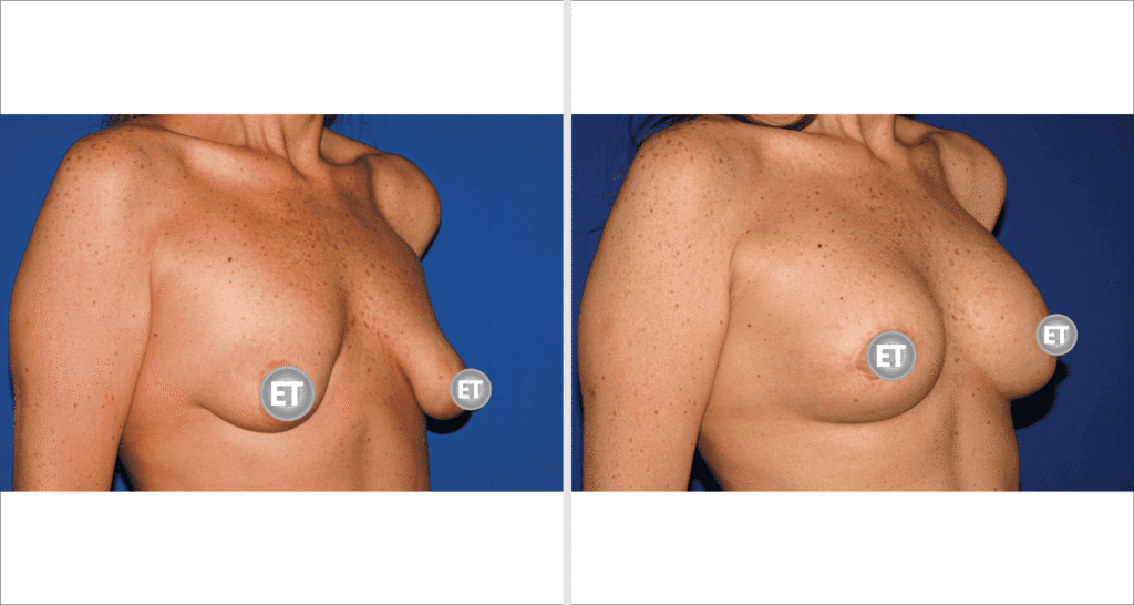 Vorher/Nachher Ergebnis: Mammatubulaere Deformitaet