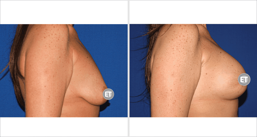 Vorher/Nachher Ergebnis: Mammatubulaere Deformitaet