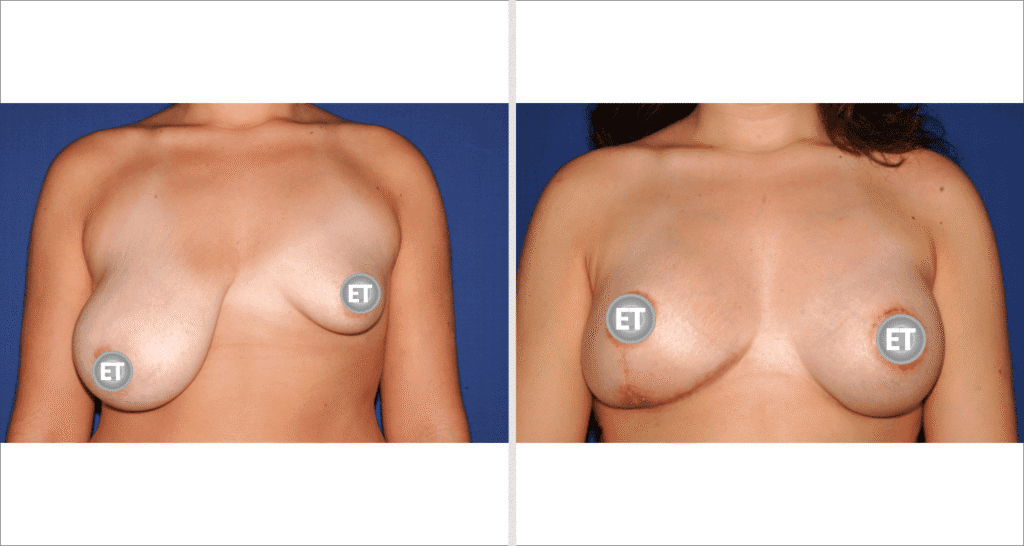 Vorher/Nachher Ergebnis: Mammatubulaere Deformitaet