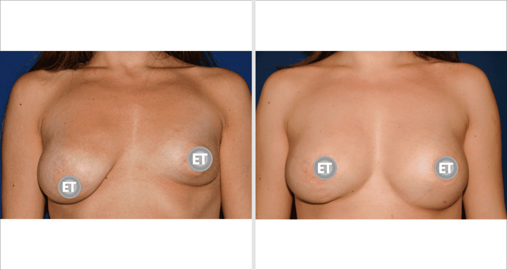 Vorher/Nachher Ergebnis: Mammatubulaere Deformitaet